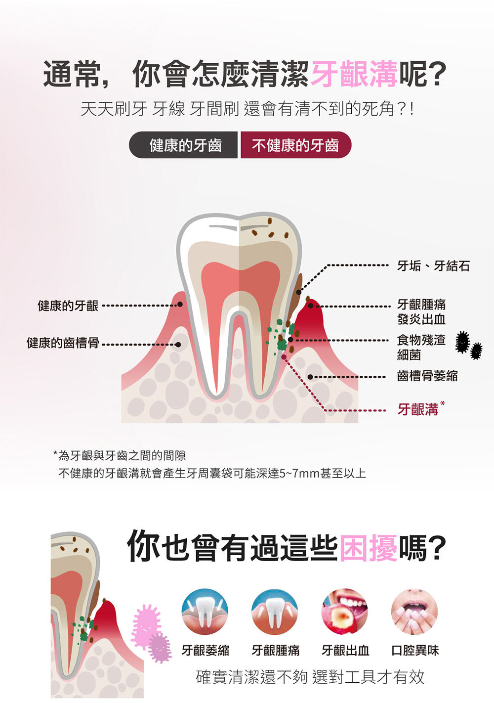不健康的牙齦溝就會產生牙周囊袋可能深達57mm甚至以上