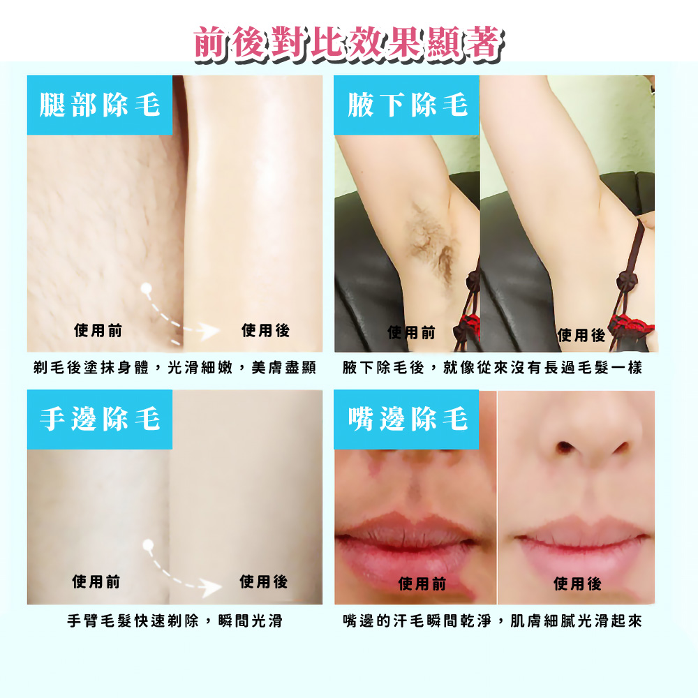 腋下除毛後,就像從來沒有長過毛髮一樣